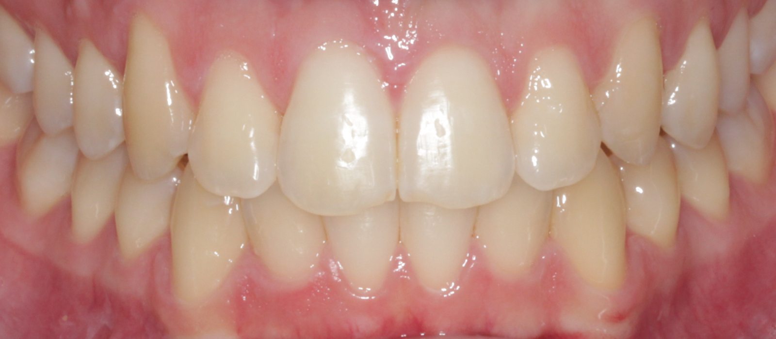 Invisalign - After