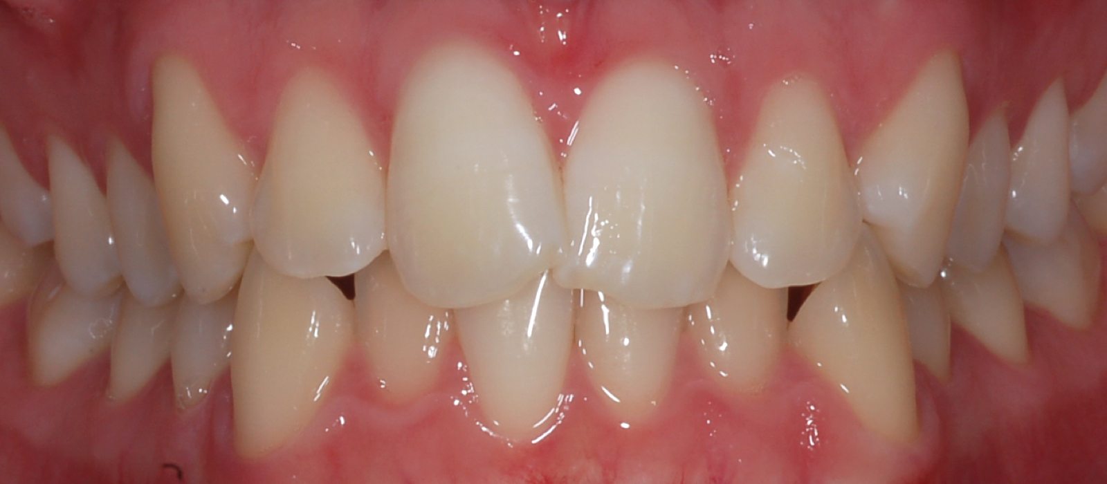Invisalign - Before