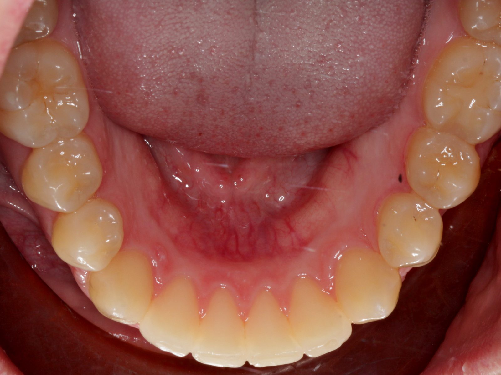 Invisalign - After