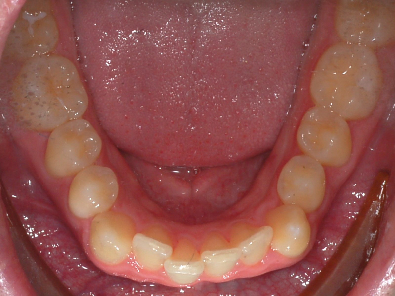 Invisalign - Before