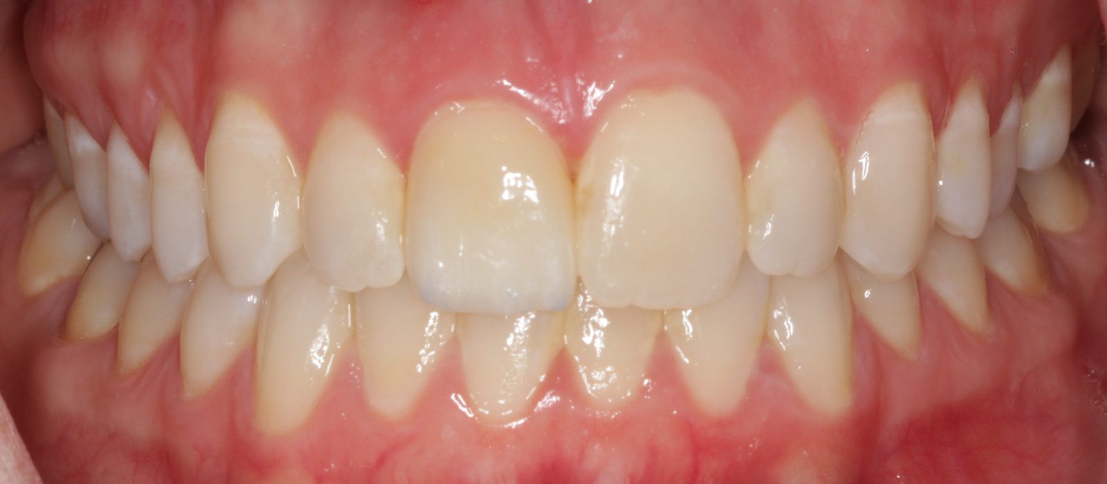 Veneers