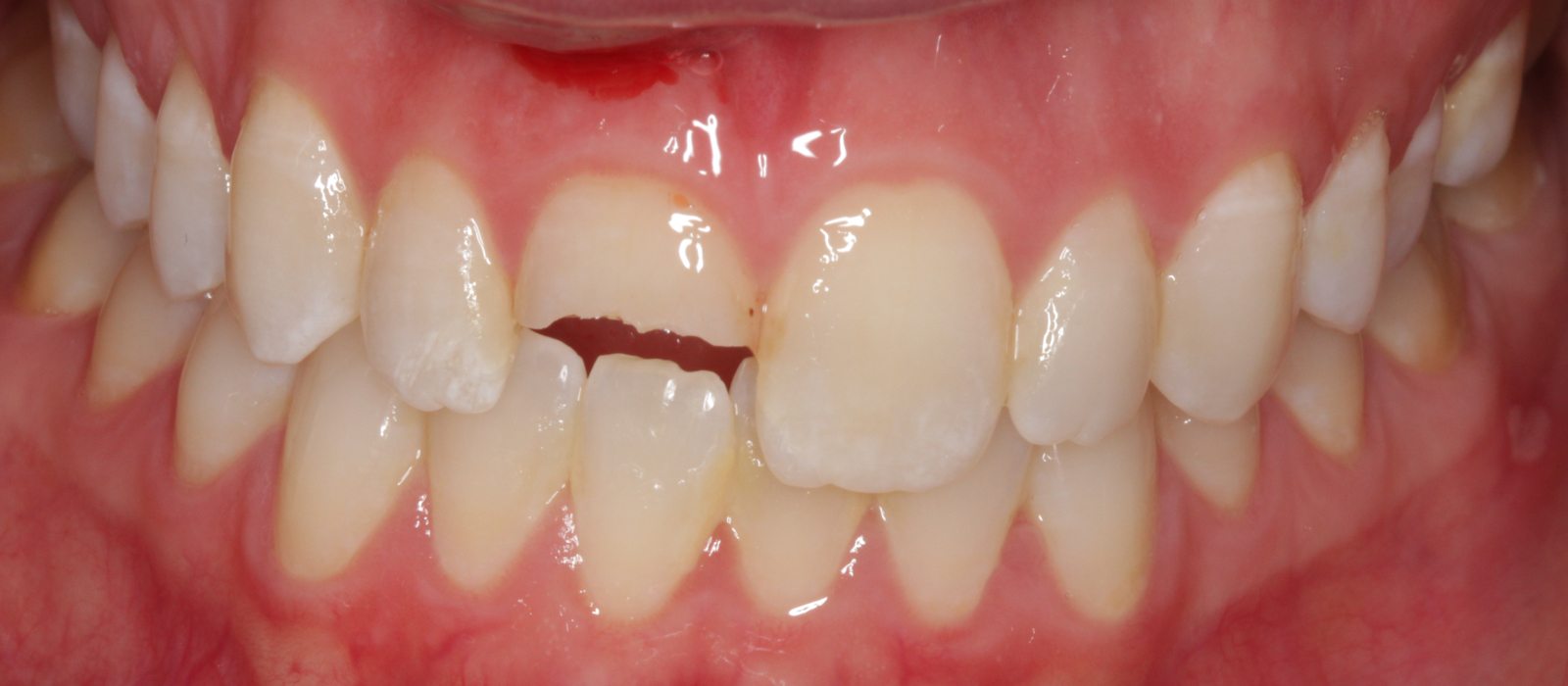 Veneers