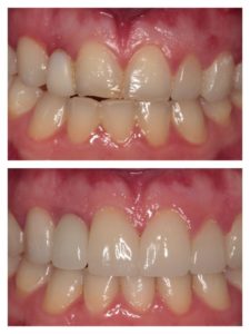 before and after dental procedure