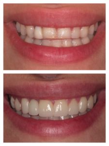 before and after dental procedure