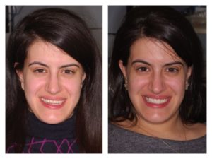 before and after dental procedure