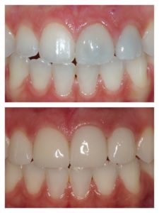 before and after dental procedure