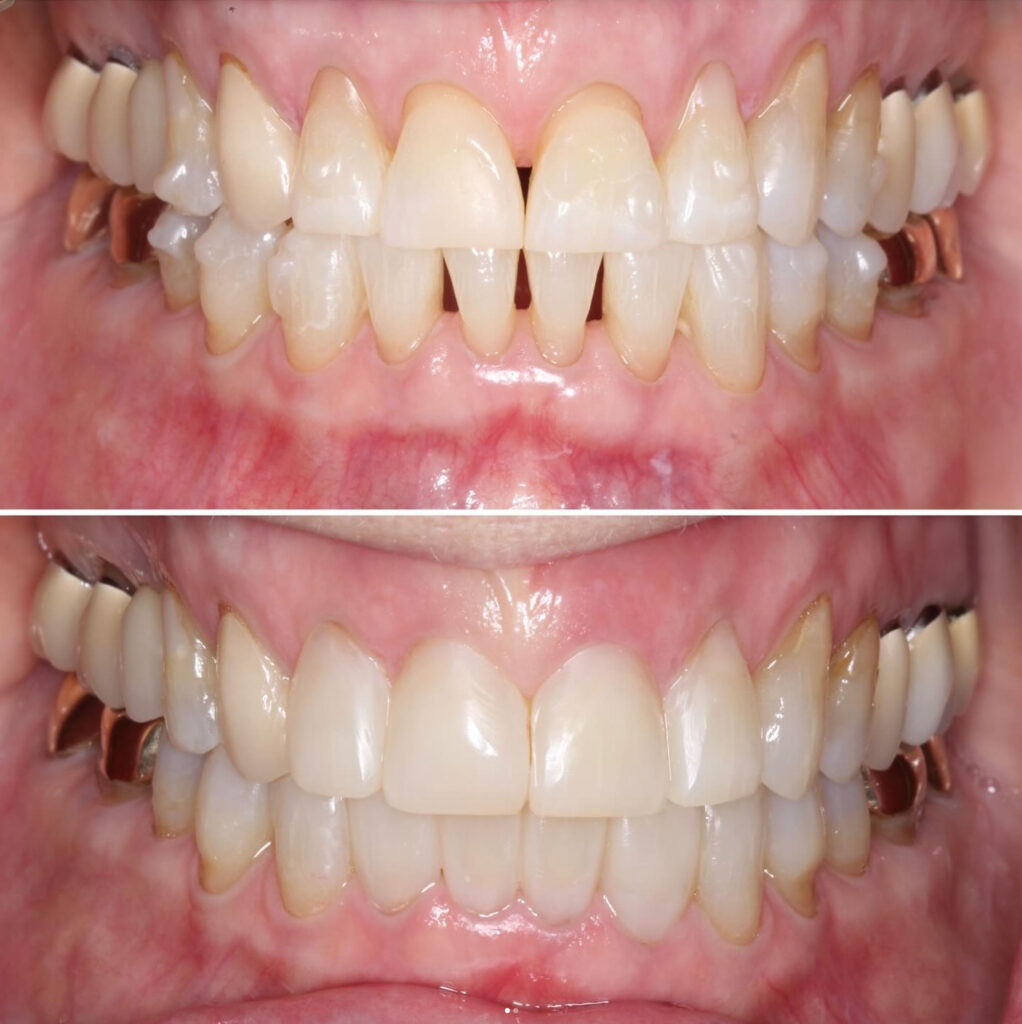 before and after